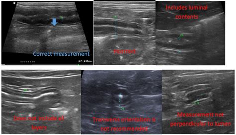 measurement of small intestine thickness|Sonography Intestinal Assessment, Protocols, and .